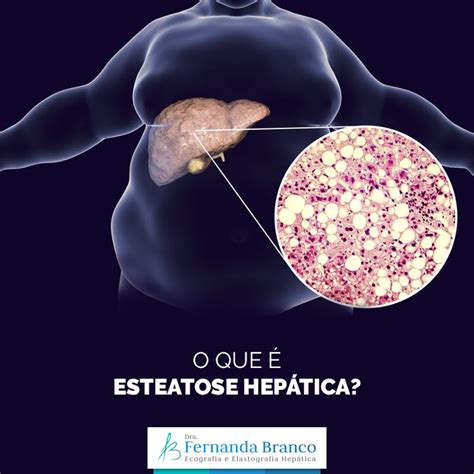 esteatose hepática acentuada - esteatose hepática moderada